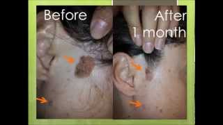 Natural treatment for seborrheic keratosis before and after photos [upl. by Ystap]