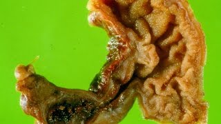 Meckels diverticulum  Pathology mini tutorial [upl. by Aznofla]