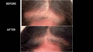 Lichen Planopilaris Treatment At Shri Skin Clinic  Dr Pravallika ThalluriVijayawada [upl. by Aruon16]