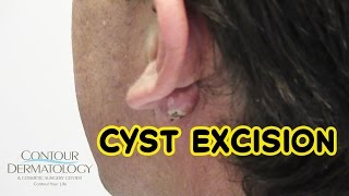 Stubborn Reoccurring Cyst Needs Removal [upl. by Larrabee]