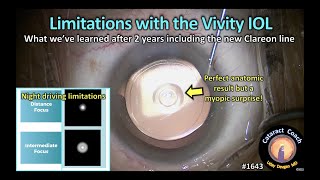 CataractCoach 1643 limitations with the Vivity IOL extended depth of focus [upl. by Ylim]