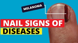 10 Nail Signs of Health Problems Subungual Melanoma Finger Clubbing Nail Pitting Brittle Nails [upl. by Mitch925]