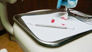 EMERGENCY TOOTH EXTRACTION [upl. by Hsemar]