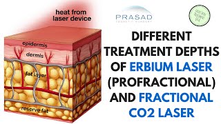 The Different Treatment Depths of ProFractional Erbium Laser and Fractional CO2 Laser [upl. by Reade]