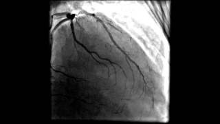 Heart angiogram coronary and three vessel disease [upl. by Neellok575]