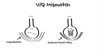 Inhaled Nitric Oxide in ICU [upl. by Lalitta]