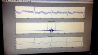 ECG signal filtering and noise reduction with MATLAB realtime result only no code [upl. by Wagshul]