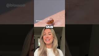 🚫 Home Skin Tag Removal Don’t Try This SkinTagRemoval [upl. by Aurore]