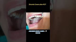 Zirconia Crown🦷❤️ dentaltreatment itahari teethcare zirconia dentalhospital viral [upl. by Agna]