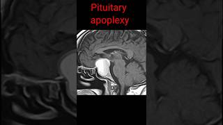 MRI Pituitary Gland shorts mribrain shortsfeed radiology [upl. by Melisande654]