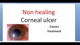 Ophthalmology 114 a Non healing corneal ulcer Cornea Causes Treatment [upl. by Reede811]