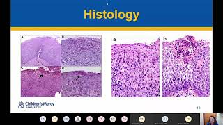 Eosinophilic Esophagitis Page [upl. by Samaj]