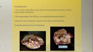 Omneya Wahba Oral cyst 4 [upl. by Zedecrem]