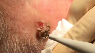 Removal of Seborrhoeic Wart [upl. by Yorle41]