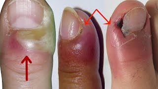 How to Treat Paronychia at Home  Home Treatment for Paronychia Nail Infection [upl. by Ennirok]