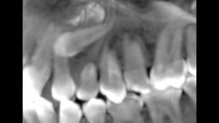 Canines incluses CBCT scan impacted cuspids orthodontie 123213 IT31 [upl. by Eagle]