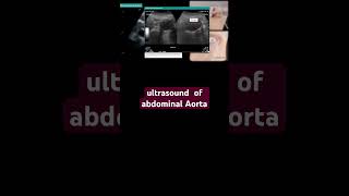 ultrasound of abdominal Aorta [upl. by Naji]