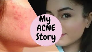 My Acne story Accutane PCOS retinoids I The Junior Doctor [upl. by Lorre]