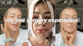 UNDERBITE JAW SURGERY  vlog  recovery days 114  before amp after [upl. by Ocisnarf]