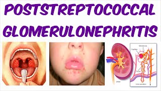 Post Streptococcal Glomerulonephritis PSGN [upl. by Honna]