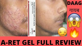 ARet 01 Gel Full Review the Secret to Clear AcneFree Skin 🌟 Saaf Aur Chamakdar Twacha [upl. by Chui211]