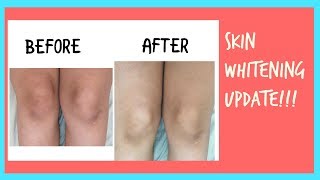 DIY skin bleaching  whiten FAST with Hydrogen Peroxide update [upl. by Louisa]