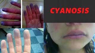 CYANOSIS  Causes Symptoms Types Treatment I What is cyanosis Peripheral and Central Cyanosis [upl. by Marin]