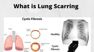 What is Lung Scarring [upl. by Jewelle]