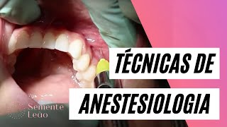 Técnicas de anestesiologia local utilizadas na Odontologia  Semente Leão  Dra Tuanny Lima [upl. by Netnilc]