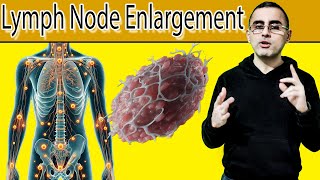 Lymph Node Enlargement Causes and Approach [upl. by Bart]