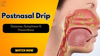 quotPostnasal Dripquot  Reasons Symptoms amp Precautions  Best ENT Hospital in Eastern India  ENT [upl. by Neelyhtak965]