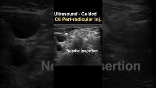 Sonoguided C6 periradicular injection [upl. by Mercier263]