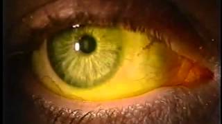 Instilling Fluorescein Dye in the Eye [upl. by Edie]