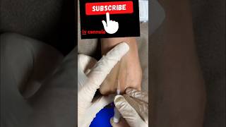 canula insertion freaks and fears ivline canular subscribe [upl. by Publus]