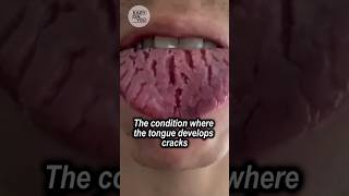 Exploring Fissured Tongue A Painful Condition with Unknown Causes [upl. by Sinned613]