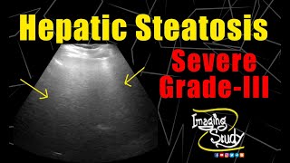 Severe Hepatic Steatosis  Severe Fatty Infiltration  Ultrasound  Case 172 [upl. by Kcirdes]