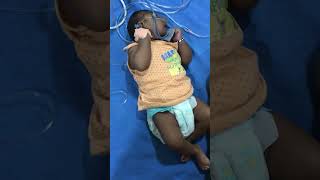 Child with microcephaly amp seizures  Pediatrics newborn shorts pediatrics seizures [upl. by Dorotea]