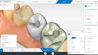 Cerec Primescan Implant Crown Design [upl. by Garges]