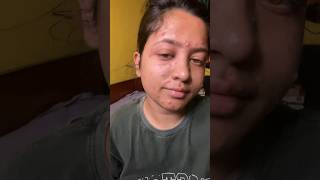 My chicken pox journey  golposongeshreya bengalivlog chickenpox pox [upl. by Orecic]