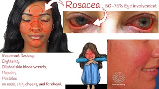 Rosacea  Red Bumpy Face Skin Rosacea Symptoms and treatment [upl. by Annawat]