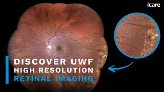 iCare EIDON UWF High Resolution Retinal Imaging [upl. by Norat555]