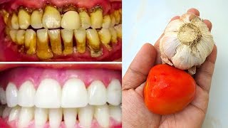 🦷 Sbianca i DENTI in 2 Minuti  rimedio casalingo NATURALE [upl. by Dole]