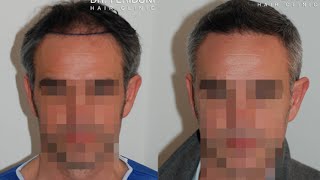 Haartransplantation mit FUE 2000 Grafts [upl. by Iddet]