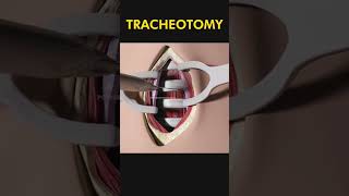 Tracheotomy 😷 explained [upl. by Illoh]