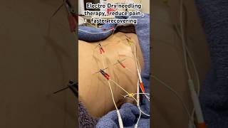 Electro Dry Needling reducepain musclespasm chronicpain sportinjury dryneedling myotherapy [upl. by Marje951]