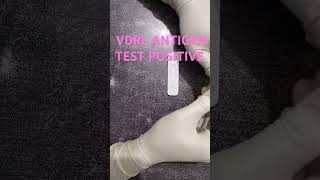 VDRL ANTIGEN TEST POSITIVE medicalcollegestudents youtubeshorts ytshorts lab [upl. by Sukhum131]