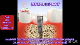 implant procedure animation dentalprocedure dentist fixedteeth bestdentalclinic bestdentist [upl. by Nnaillek]