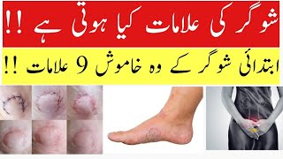 Diabetes and Its Common Symptoms Sugar Ki Alamat Kya Hoti Hai  Dr Kashif Ali [upl. by Zerimar]