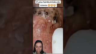 Blackheads Removal  Acne Treatment and Very Satisfying Satisfying Pimple pop blackheads [upl. by Emlen886]