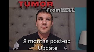 Mediastinal Teratoma Tumor 8mo postop Update [upl. by Brunn44]